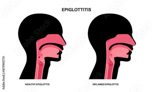 Epiglottitis medical poster
