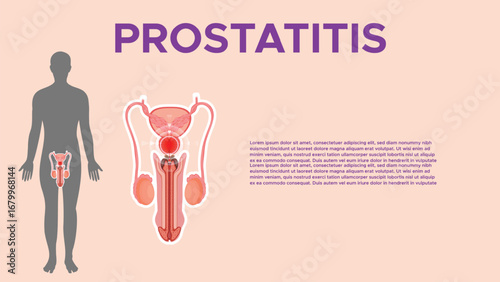Prostatitis Medical Illustration of Inflamed Prostate Gland
