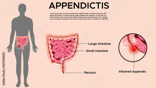 Appendicitis Medical Concept Human Digestive System with Inflamed Appendix Illustration