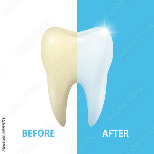 Tooth Whitening Before, After. Vector Illustration. Dental Care and Healthy Smile Concept. Cosmetic Teeth Whitening, Enamel Cleaning, Bright White Tooth, Oral Hygiene, Dental Treatment, Perfect Smile