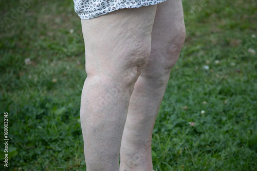 Photos Symptoms of lymphedema and venous insufficiency in an overweight senior