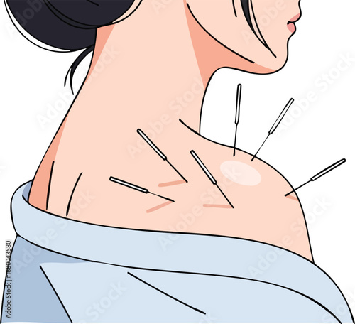 Acupuncture Treatment on Womans Shoulder.