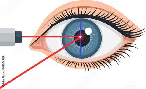 Eye with Laser Beam for Vision Correction Illustration