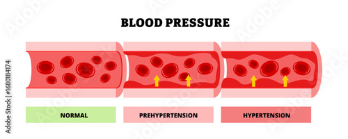 Blood pressure levels diagram showing normal or healthy, prehypertension, hypertension stages within blood vessels structure. Medical science healthcare treatment. Cardiovascular heart illustration.