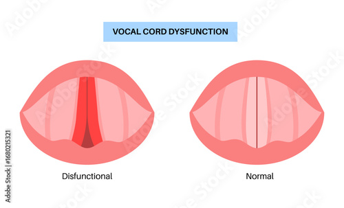 Vocal cords dysfunction