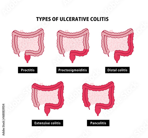 Types of ulcerative colitis. Vector illustration