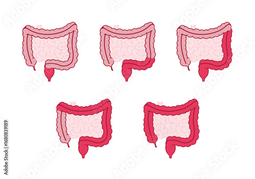Types of ulcerative colitis. Vector illustration