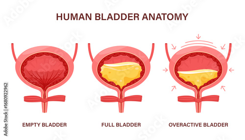 Overactive bladder, often leak anuria, bed wetting toilet urination, urge pass urine of pelvic.