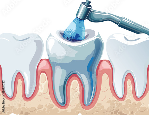 Cross-sectional dental image showing cavity and treatment tool, used for science education and health awareness among children.
