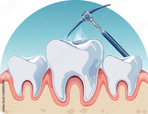 Visual representation of dental decay and gum structure with tool, used in educational campaigns for oral hygiene awareness.
