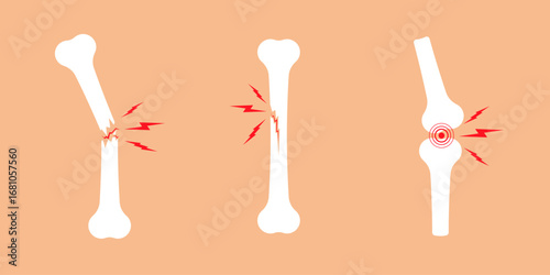Bone injuries and joint pain icons. Fractures and inflammation symbols with red lightning bolts. Medical anatomy illustration for healthcare concepts.