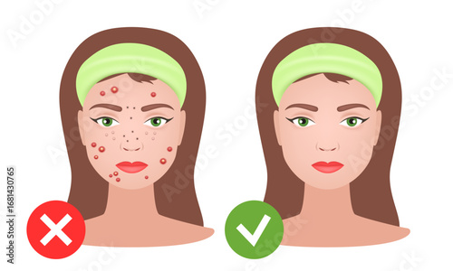 Acne skin and healthy skin. Girl with acne. Vector illustration