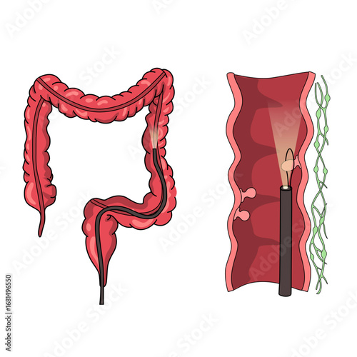 Illustration of polyp removal in the colon. Inflammatory and hamartomatous. Pain and inflammation in the human body. Illustration of internal organ examination. Vector for medical poster and science