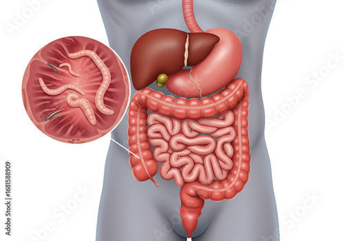 Illustration of the human digestive system with a magnified view of intestinal worms.