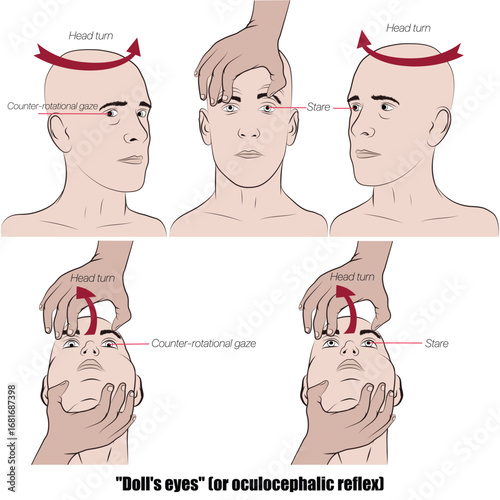 Doll's eyes or oculocephalic reflex, a neurological maneuver that evaluates brainstem function in unconscious patients.