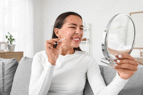 Obraz na plátně Young woman ill with chickenpox and mirror smearing spots at home