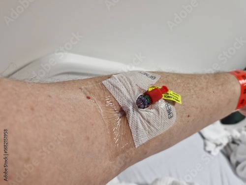 Cannula in arm