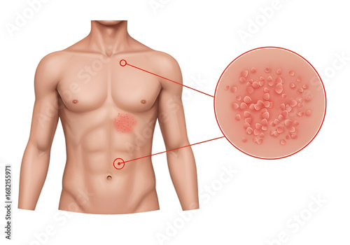 Medical illustration showing torso with skin rash and magnified view of affected area.
