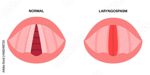 Laryngospasm medical poster