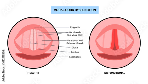 Vocal cords dysfunction
