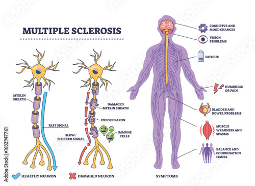 Multiple sclerosis overview showing neuron damage, immune cells, and main symptoms in a clear outline diagram. Outline diagram
