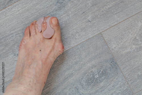 Slika na platnu Top view of a deformed foot with hallux valgus wearing a soft orthopedic toe sep