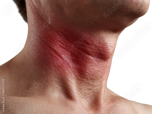 Redness and Skin Irritation: An unflinching gaze at a neck affected by a red skin irritation, likely caused by a rash, the image offers a direct portrayal of a common physical experience.