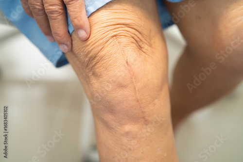 Asian elderly woman patient show her scars surgical total knee joint replacement Suture wound surgery arthroplasty.