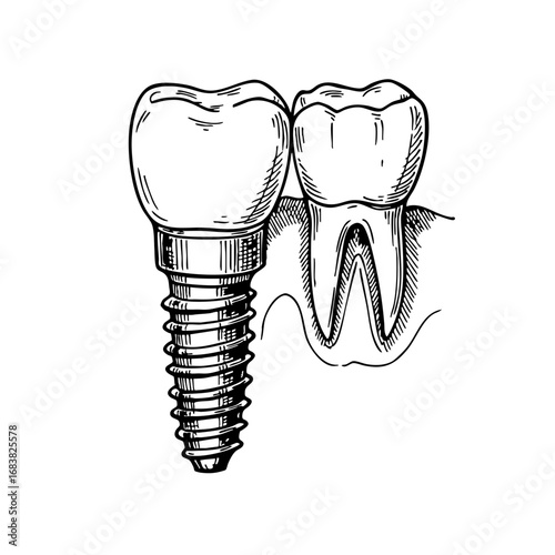 Dental implant sketch showing artificial and natural teeth  