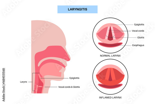 Laryngitis medical poster