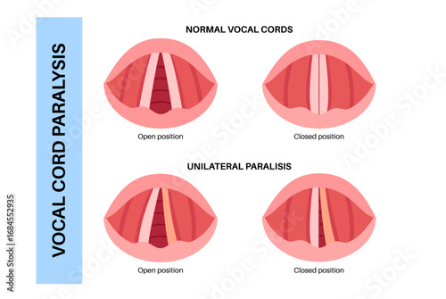Vocal cords paralysis
