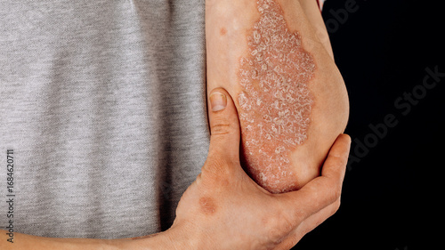 Acute psoriasis on the elbows is an autoimmune incurable dermatological skin disease. A large red, inflamed, flaky rash on the elbows. Joints affected by psoriatic arthritis