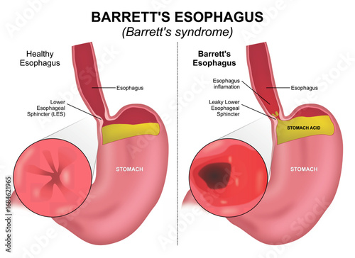 Barretts Esophagus, Barretts syndrome stomach flashcard illustration