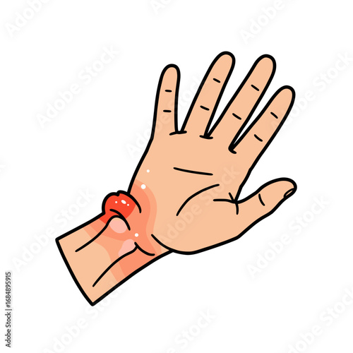 Hand with arthritis swelling showing inflamed joint detail  