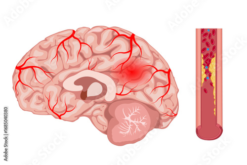 Cerebrovascular disease, stroke, brain, blood vessel blockage