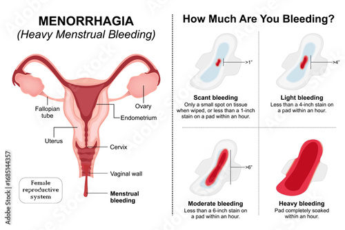Heavy Menstrual Bleeding (Menorrhagia) flashcard illustration