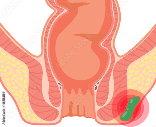 Ischiorectal Abscess 