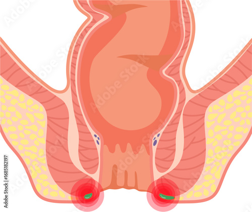 Perineal Abscess 