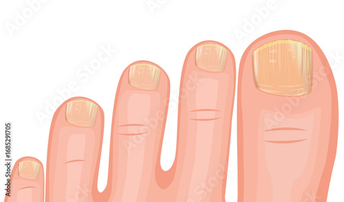 toenaul fungus toe foot infection desease