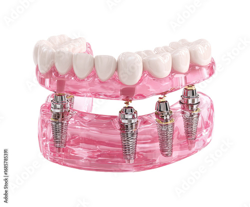 3D rendering of dental implants securing a lower denture.  Pink gums, teeth, and clear jaw.  Visible dental implants