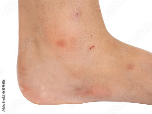 Skin on the feet and legs with scars and dark spots makes the skin unattractive, skincare concept.