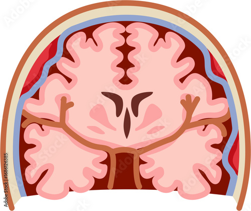 Epidural Hematoma 