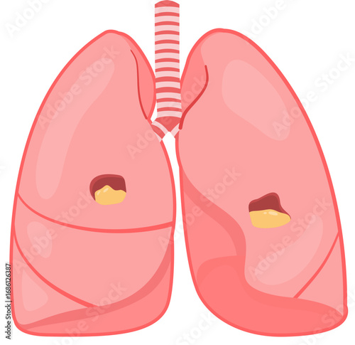 Lung Abscess 