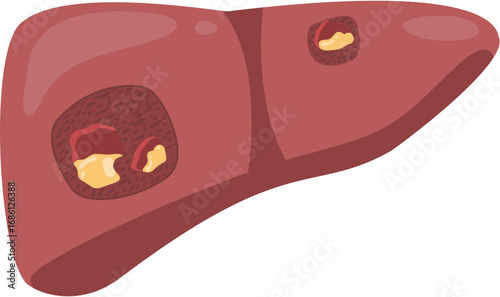 Liver Abscess 