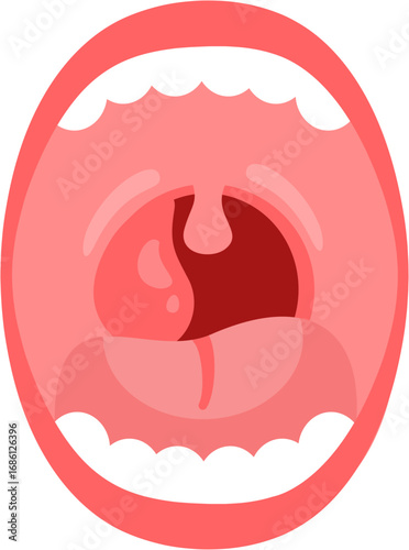 Peritonsillar Abscess 