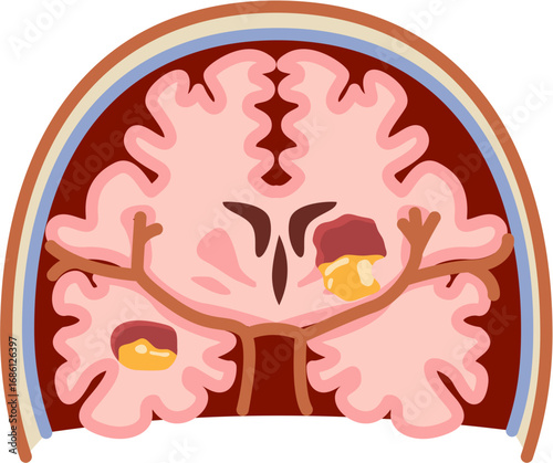 Brain Abscess 
