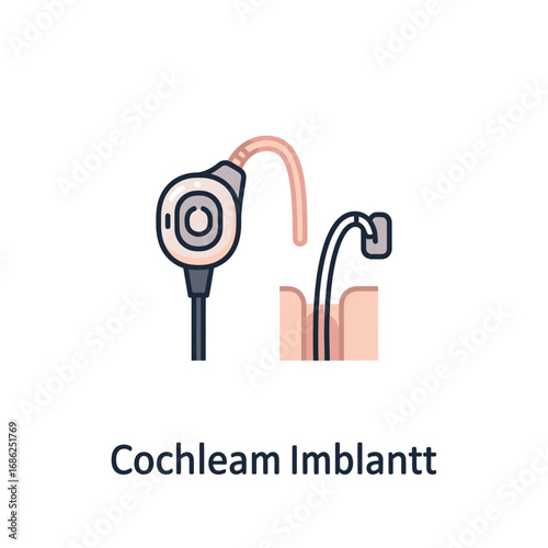 Cochlear implant device illustration showing external processor and internal electrode array implanted in the ear.