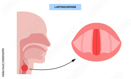 Laryngospasm medical poster