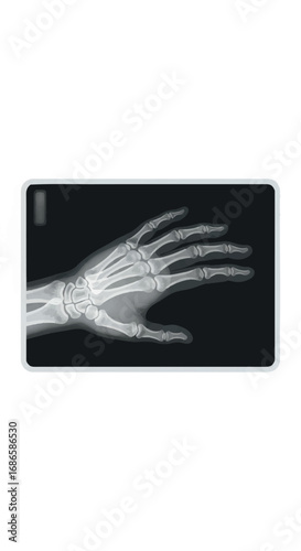 Xray of a human hand showing bones and joints.