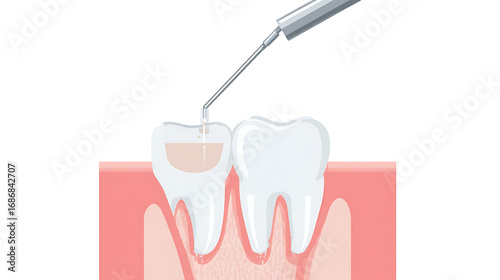 Dental scaling procedure with dental instrument cleaning teeth in medical clinic